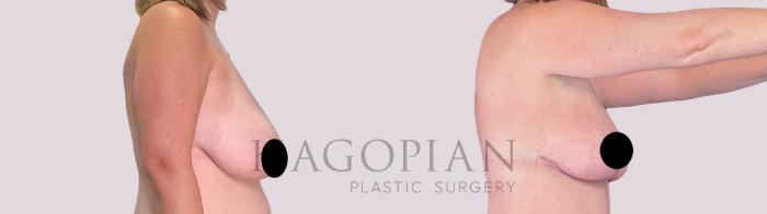 Before & After Breast Lift Case 256 Right Side View in Atlanta, GA