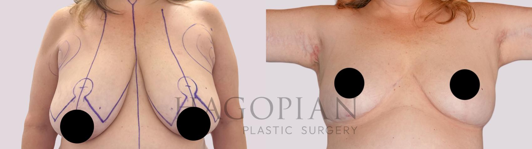 Before & After Breast Lift Case 263 Front View in Atlanta, GA