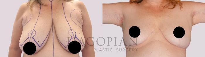 Before & After Breast Lift Case 263 Front View in Atlanta, GA