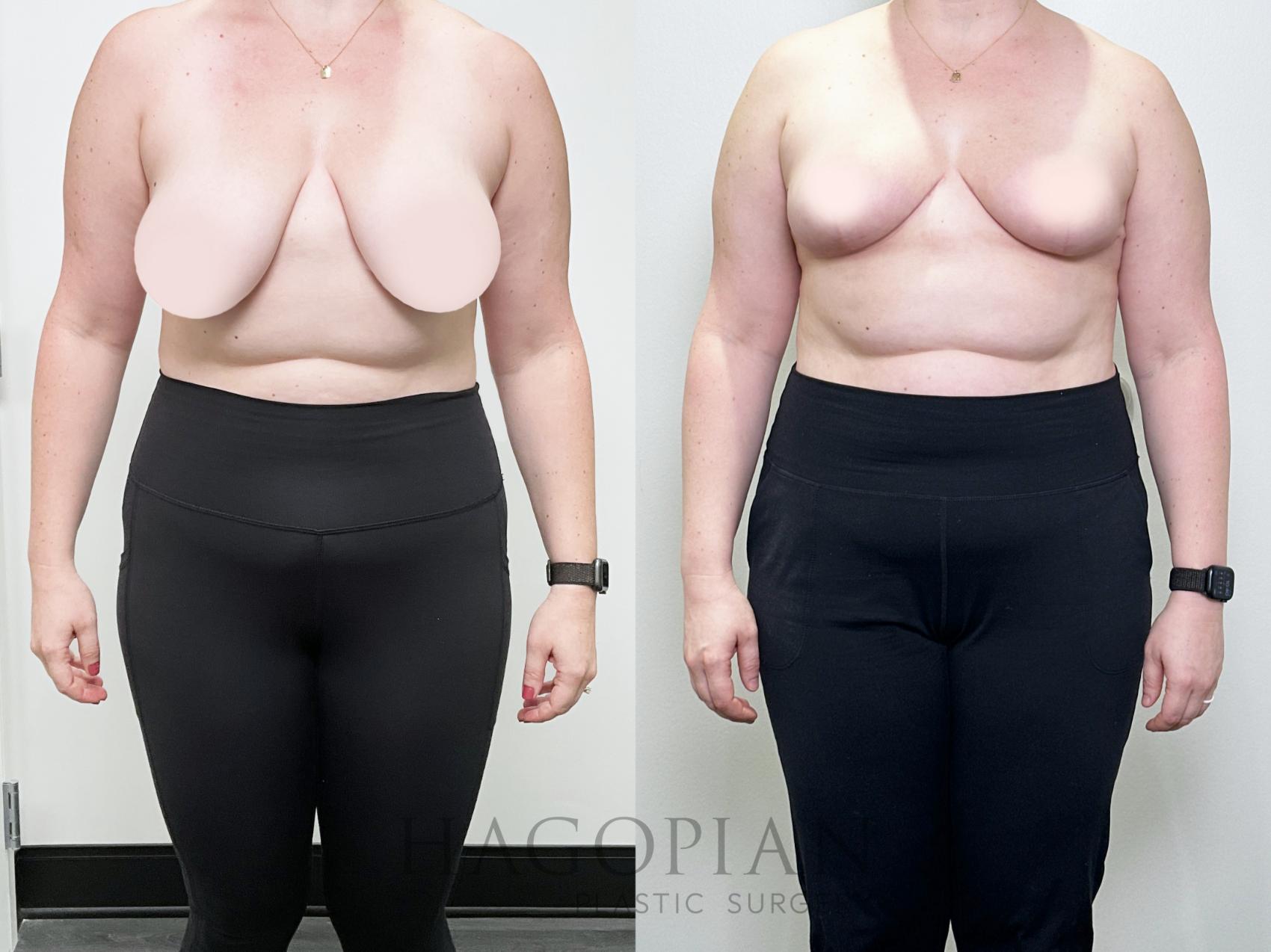 Before & After Breast Reduction Case 104 Front View in Atlanta, GA