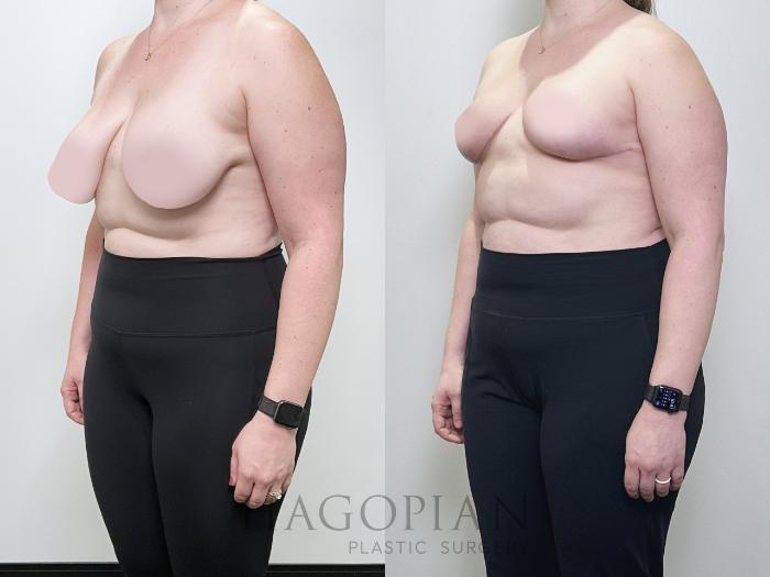 Before & After Breast Reduction Case 104 Left Oblique View in Atlanta, GA