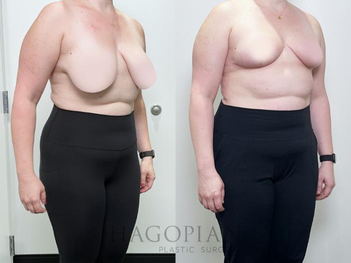 Before & After Breast Reduction Case 104 Right Oblique View in Atlanta, GA