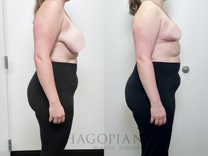 Before & After Breast Reduction Case 104 Right Side View in Atlanta, GA