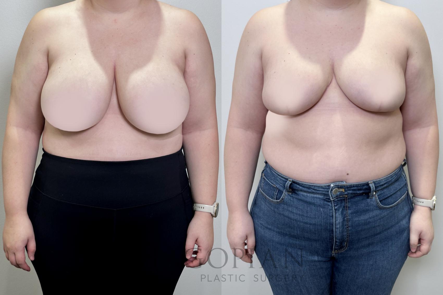 Before & After Breast Reduction Case 109 Front View in Atlanta, GA