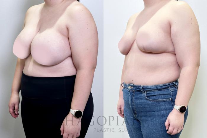 Before & After Breast Reduction Case 109 Left Oblique View in Atlanta, GA