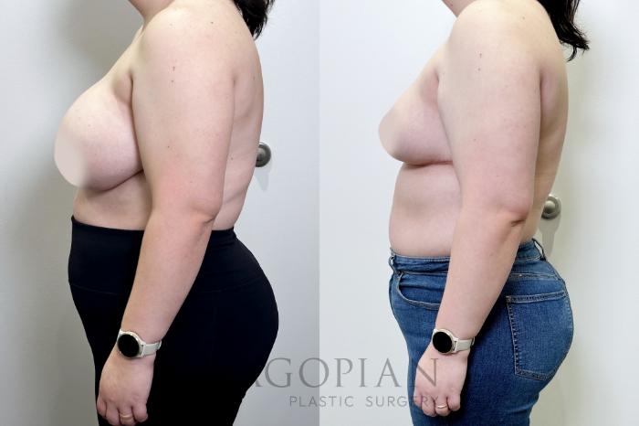 Before & After Breast Reduction Case 109 Left Side View in Atlanta, GA
