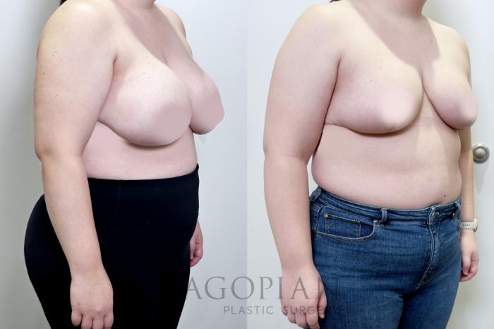 Before & After Breast Reduction Case 109 Right Oblique View in Atlanta, GA