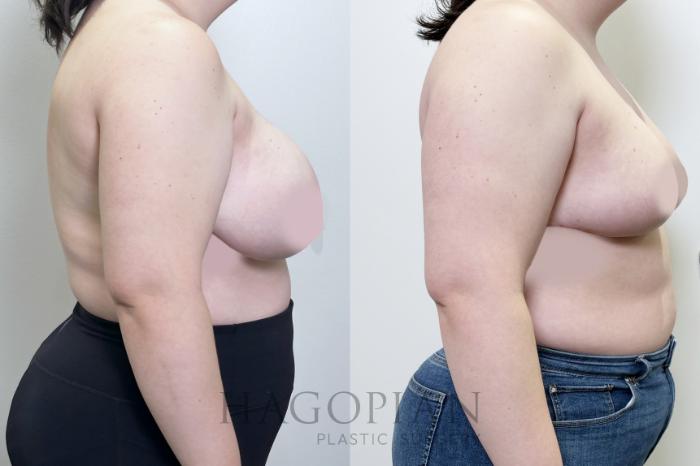 Before & After Breast Reduction Case 109 Right Side View in Atlanta, GA