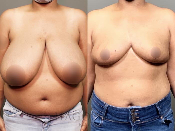 Before & After Breast Reduction Case 13 Front View in Atlanta, GA