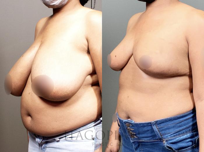 Before & After Breast Reduction Case 13 Left Oblique View in Atlanta, GA