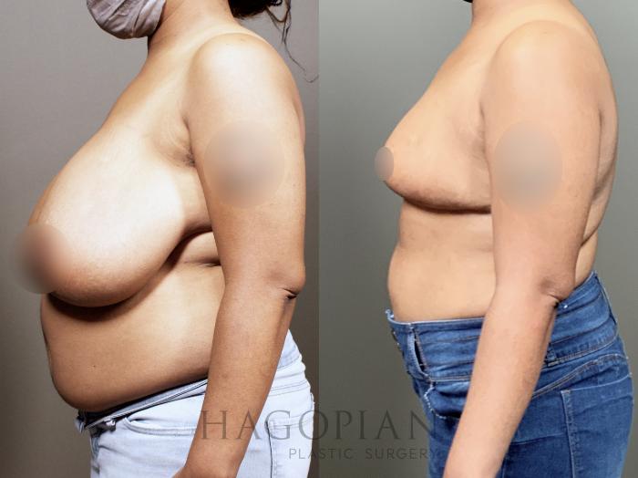Before & After Breast Reduction Case 13 Left Side View in Atlanta, GA