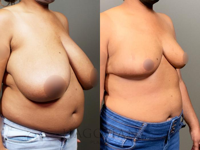 Before & After Breast Reduction Case 13 Right Oblique View in Atlanta, GA
