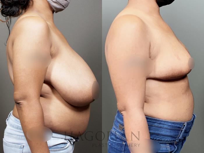 Before & After Breast Reduction Case 13 Right Side View in Atlanta, GA