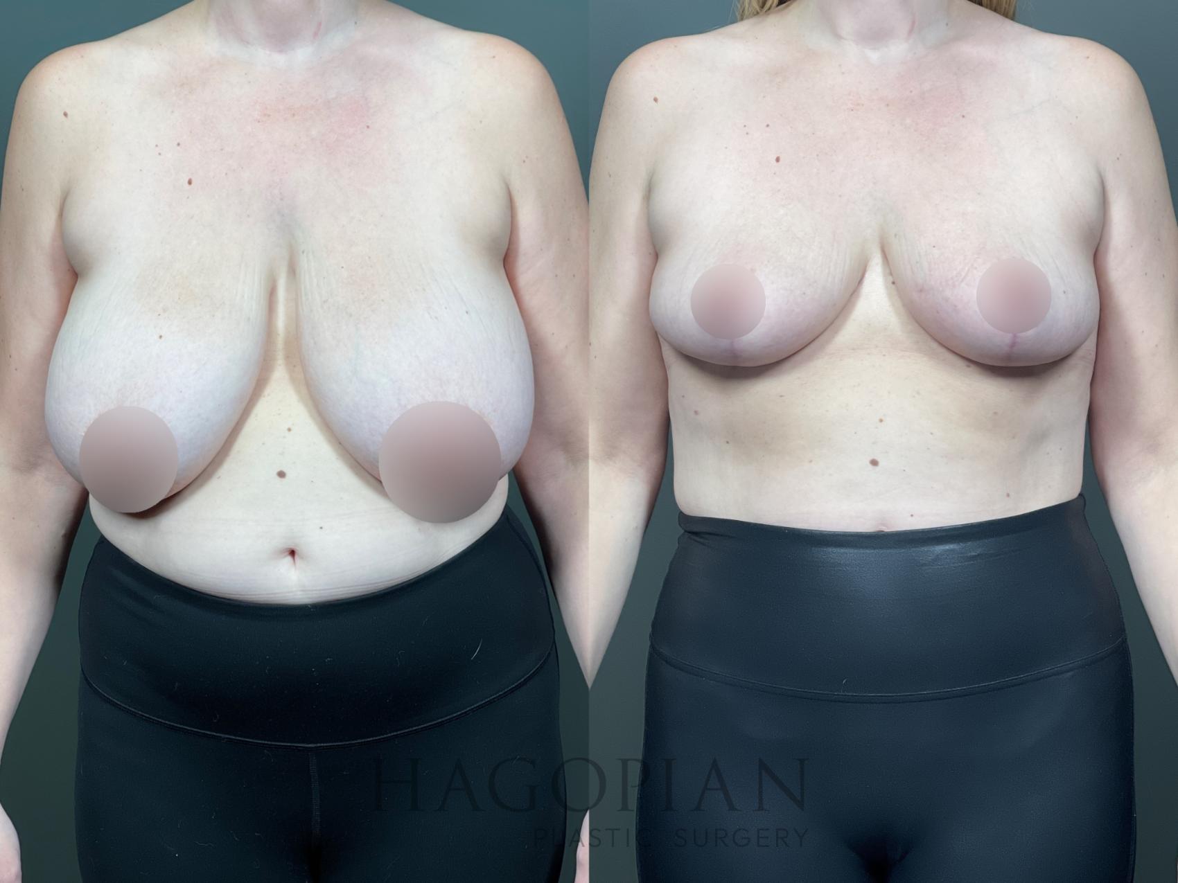 Before & After Breast Reduction Case 14 Front View in Atlanta, GA