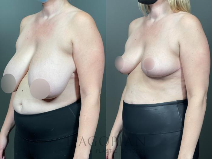 Before & After Breast Reduction Case 14 Left Oblique View in Atlanta, GA