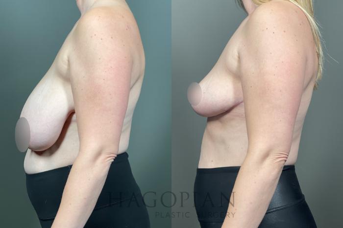 Before & After Breast Reduction Case 14 Left Side View in Atlanta, GA