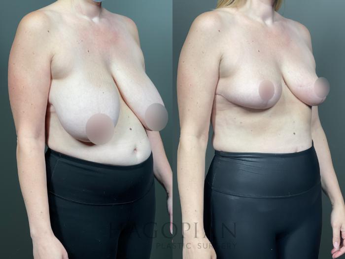 Before & After Breast Reduction Case 14 Right Oblique View in Atlanta, GA