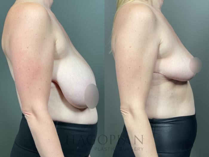Before & After Breast Reduction Case 14 Right Side View in Atlanta, GA