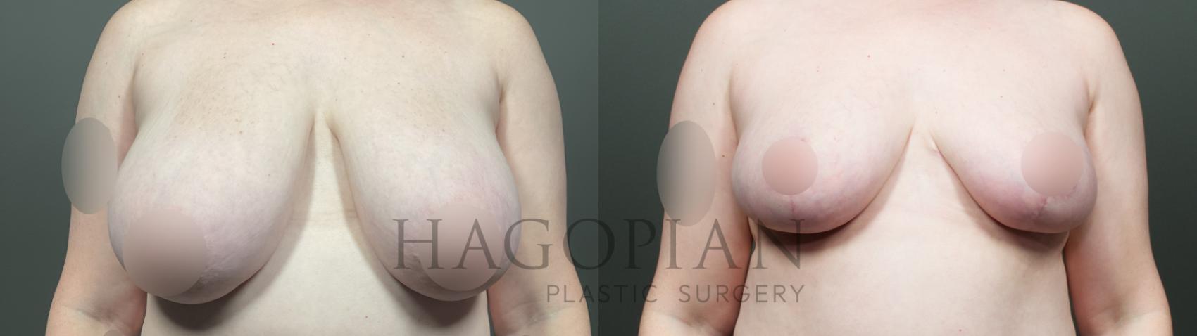 Before & After Breast Reduction Case 19 Front View in Atlanta, GA