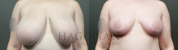 Before & After Breast Lift Case 19 Front View in Atlanta, GA