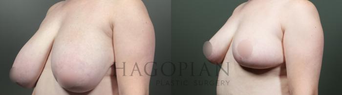 Before & After Breast Reduction Case 19 Left Oblique View in Atlanta, GA