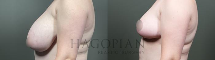Before & After Breast Reduction Case 19 Left Side View in Atlanta, GA