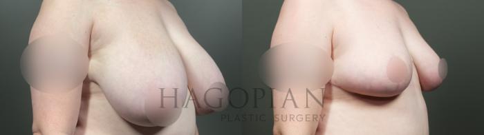 Before & After Breast Reduction Case 19 Right Oblique View in Atlanta, GA