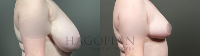 Before & After Breast Reduction Case 19 Right Side View in Atlanta, GA