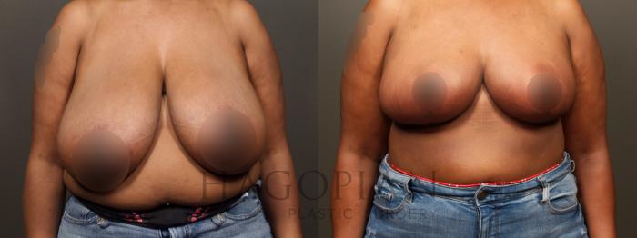 Before & After Breast Reduction Case 32 Front View in Atlanta, GA