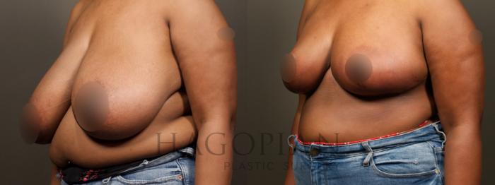Before & After Breast Reduction Case 32 Left Oblique View in Atlanta, GA