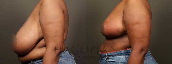 Before & After Breast Reduction Case 32 Left Side View in Atlanta, GA