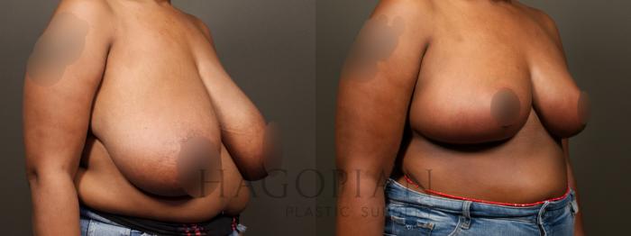 Before & After Breast Lift Case 32 Right Oblique View in Atlanta, GA
