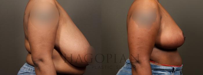 Before & After Breast Reduction Case 32 Right Side View in Atlanta, GA