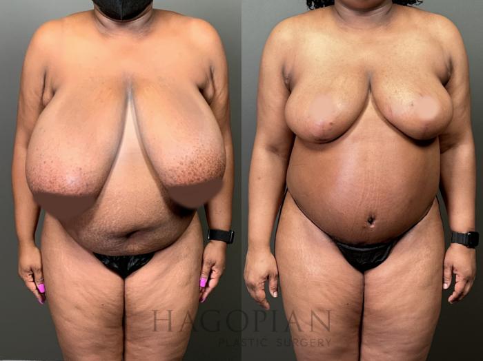 Before & After Breast Reduction Case 57 Front View in Atlanta, GA