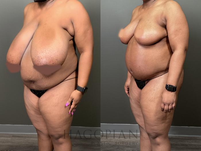 Before & After Breast Reduction Case 57 Left Oblique View in Atlanta, GA