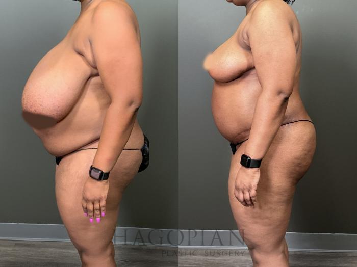 Before & After Breast Reduction Case 57 Left Side View in Atlanta, GA