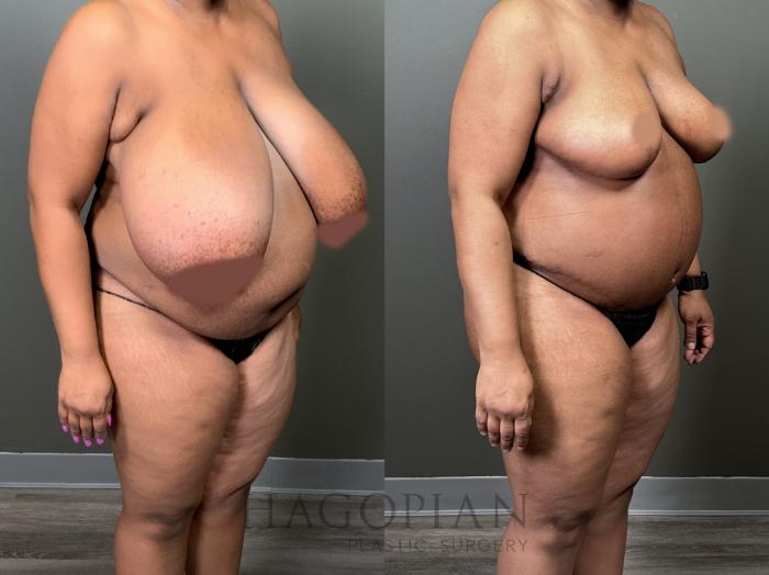 Before & After Breast Reduction Case 57 Right Oblique View in Atlanta, GA