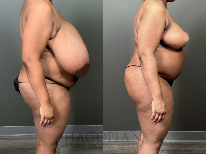 Before & After Breast Reduction Case 57 Right Side View in Atlanta, GA