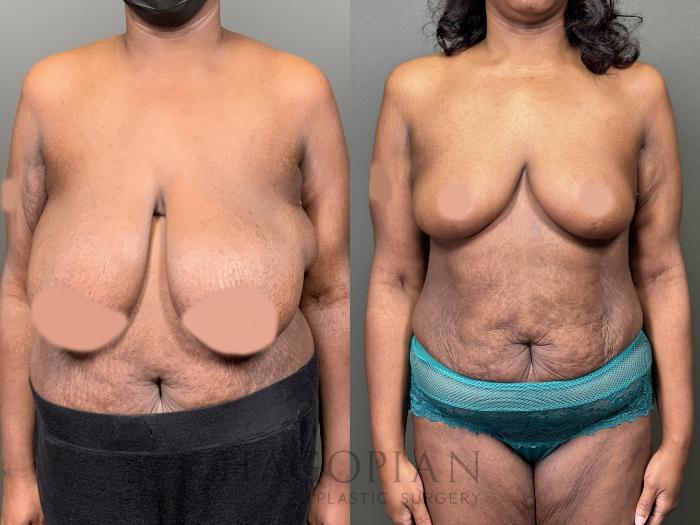 Before & After Breast Reduction Case 58 Front View in Atlanta, GA