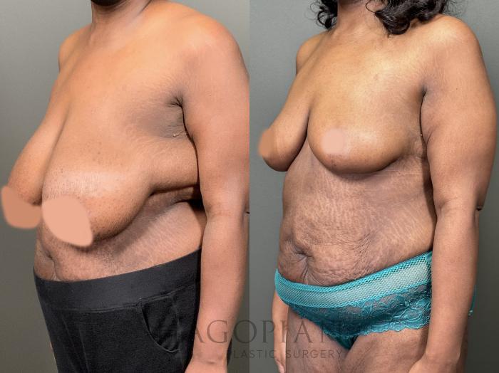 Before & After Breast Reduction Case 58 Left Oblique View in Atlanta, GA