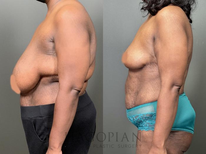 Before & After Breast Reduction Case 58 Left Side View in Atlanta, GA