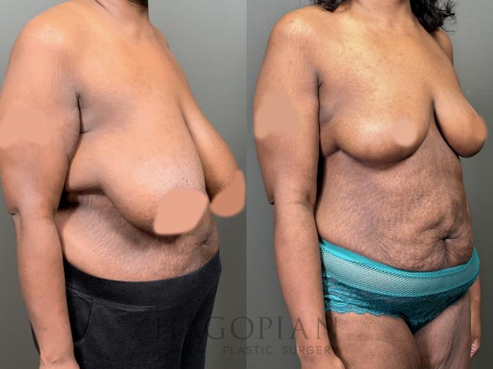 Before & After Breast Reduction Case 58 Right Oblique View in Atlanta, GA
