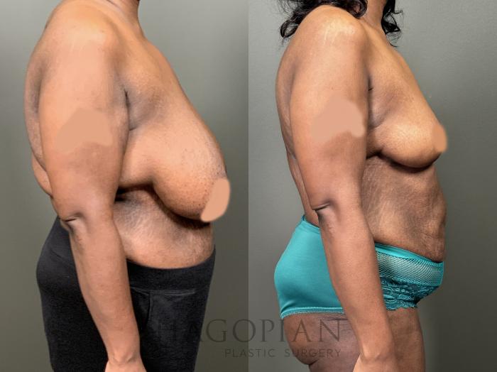 Before & After Breast Reduction Case 58 Right Side View in Atlanta, GA