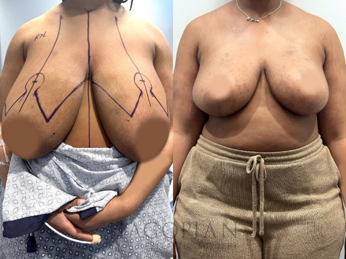 Before & After Breast Reduction Case 64 Front View in Atlanta, GA