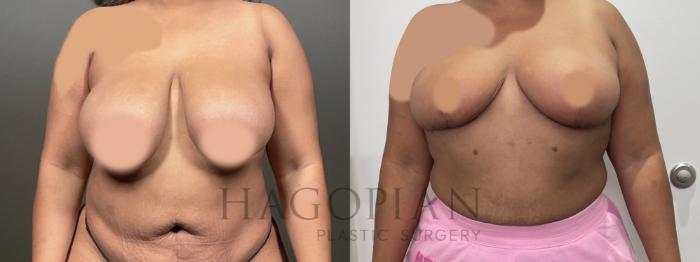 Before & After Breast Reduction Case 78 Front View in Atlanta, GA
