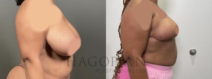 Before & After Breast Reduction Case 78 Right Side View in Atlanta, GA