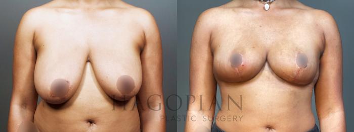 Before & After Breast Reduction Case 8 Front View in Atlanta, GA