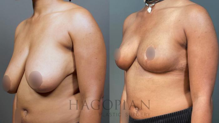 Before & After Breast Reduction Case 8 Left Oblique View in Atlanta, GA