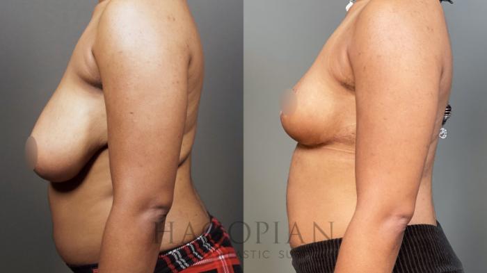 Before & After Breast Reduction Case 8 Left Side View in Atlanta, GA