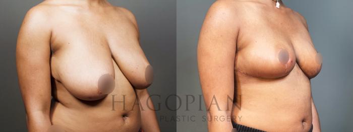 Before & After Breast Reduction Case 8 Right Oblique View in Atlanta, GA